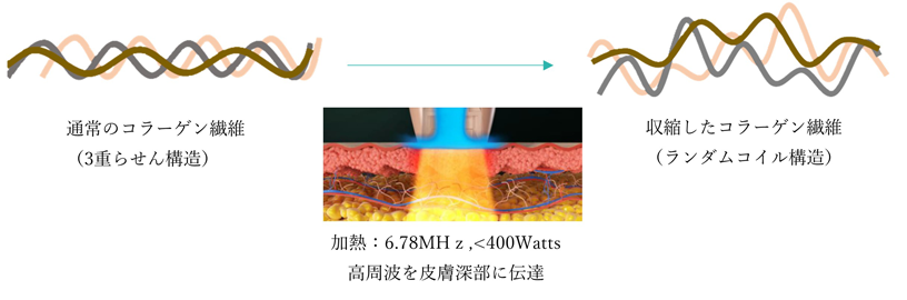 創傷治癒過程による長期的なコラーゲン・エラスチンの生成